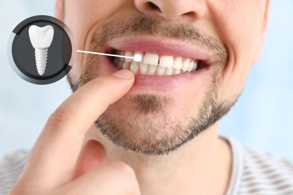 Marlton Modern Dentistry | Dental Implants In Marlton, NJ: What To Expect From Consultation To Confident Bite