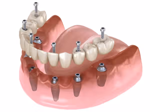 Implant Deals