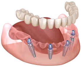 Implant Deals