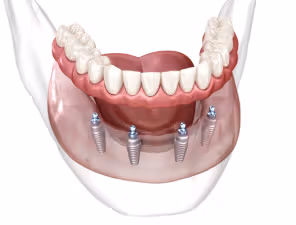 Implant Deals