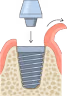 Implant Deals