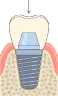 Implant Deals