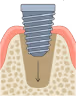 Implant Deals