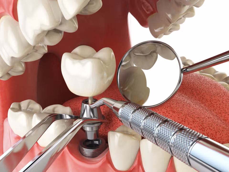 Implant Deals