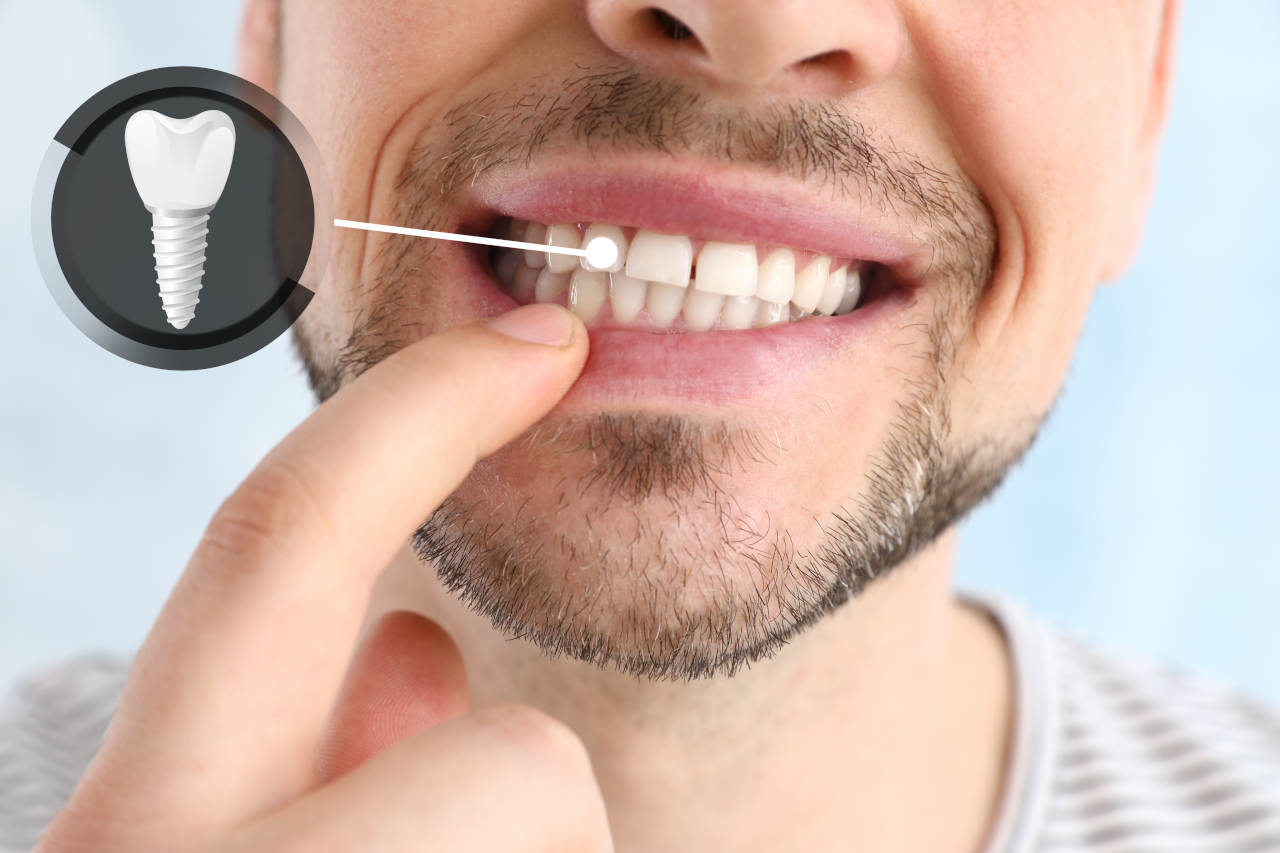 Are Dental Implants Worth It? A Complete Guide for Patients in Marlton, NJ Are Dental Implants Worth It? A Complete Guide for Patients in Marlton, NJ