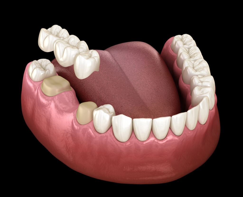 Dental Bridges in Marlton, NJ: How Traditional Bridges Replace Missing Teeth Dental Bridges in Marlton, NJ: How Traditional Bridges Replace Missing Teeth